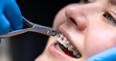Foods to Skip During the First Month With Braces Foods to Skip During the First Month With Braces